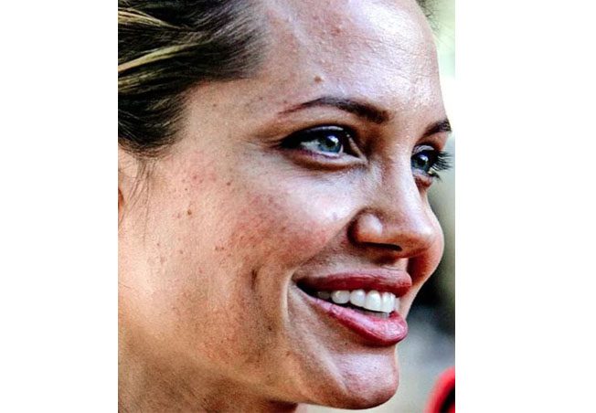 نجمات لا يزلن يعانين من حبّ الشباب حتى اليوم...ولا يخجلن من ذلك