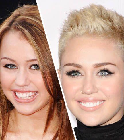 مايلي سايرس ومقوّم أسنان خلفي غير مرئي