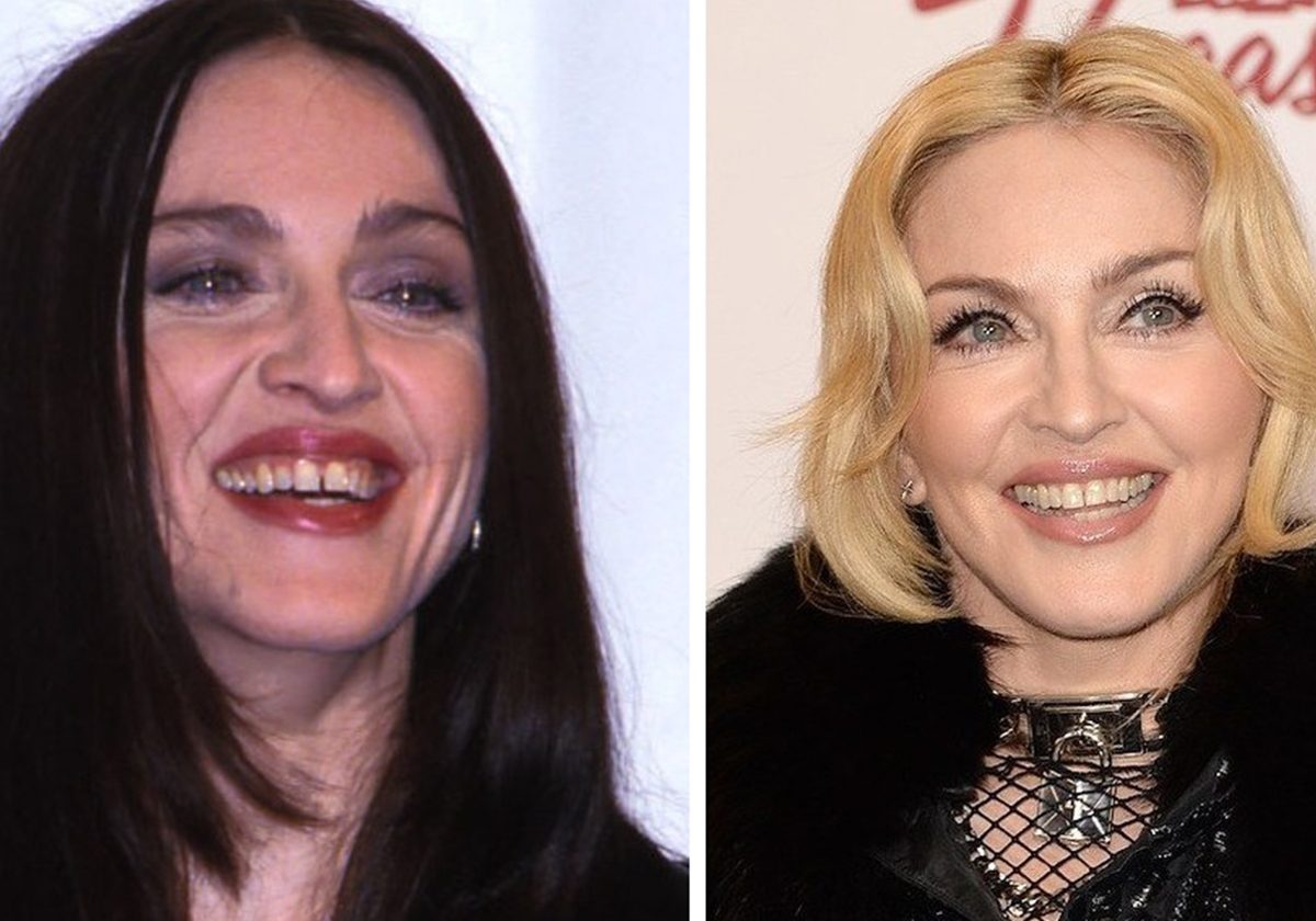صور مادونا قبل تجميل الأسنان وبعدها
