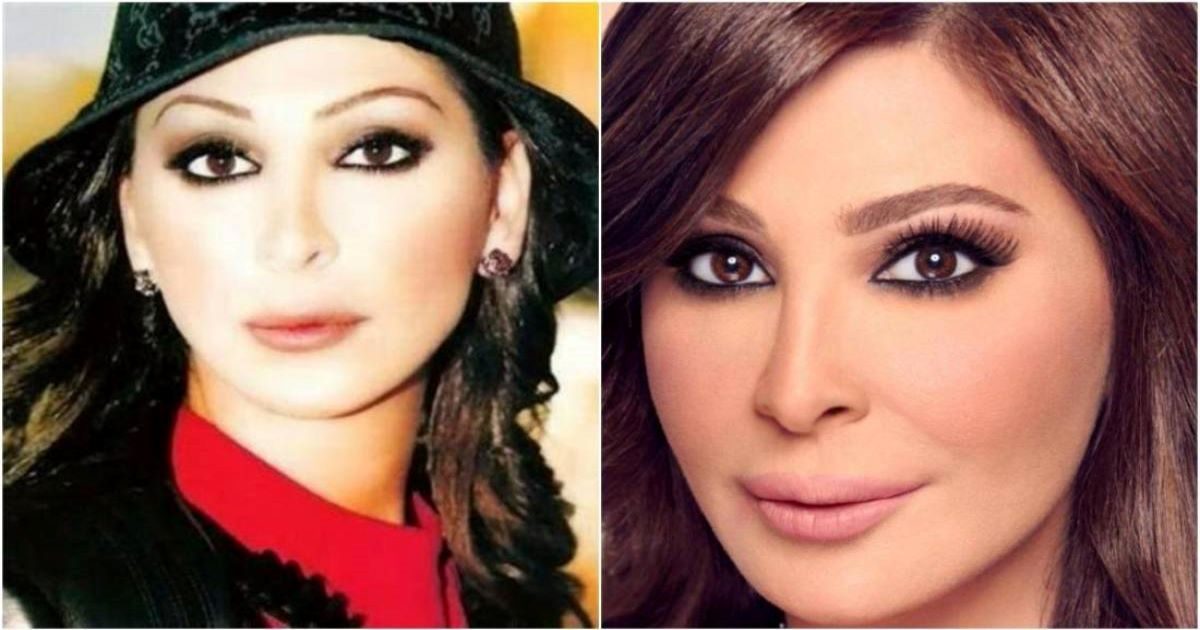 نجمات قبل وبعد فيلر الشفايف