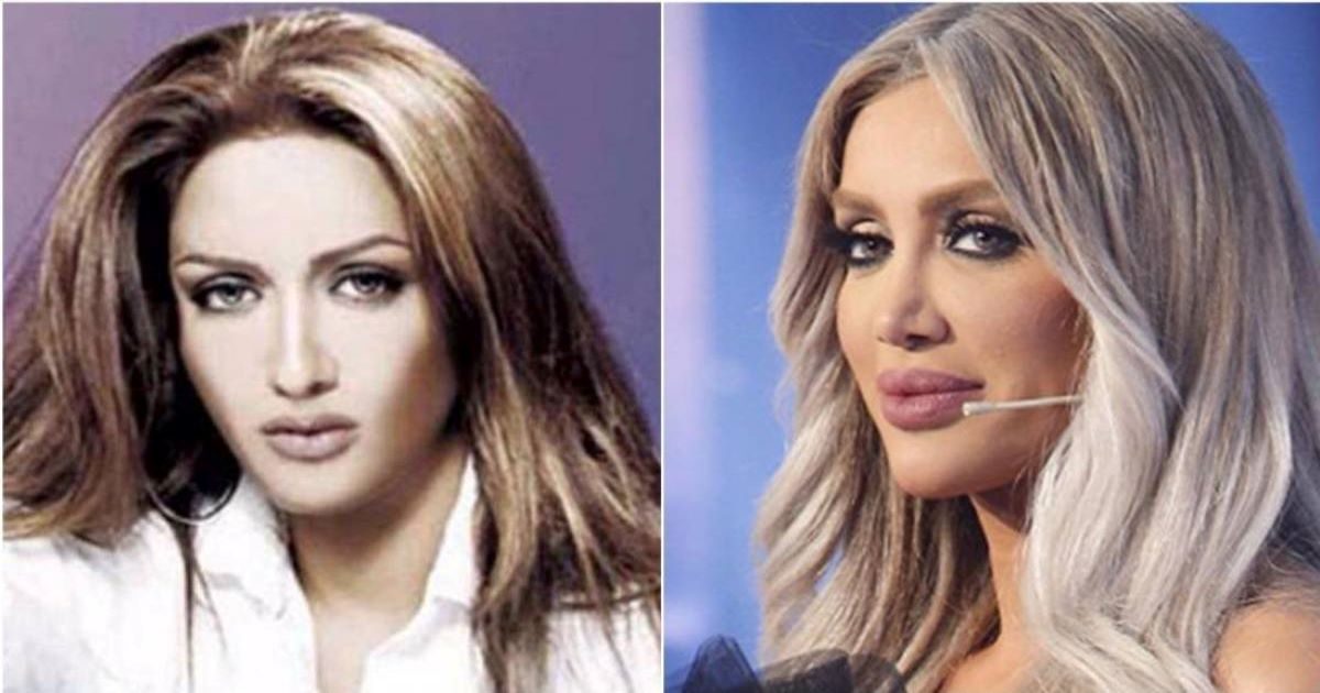 تغيرات بعد فيلر الشفايف