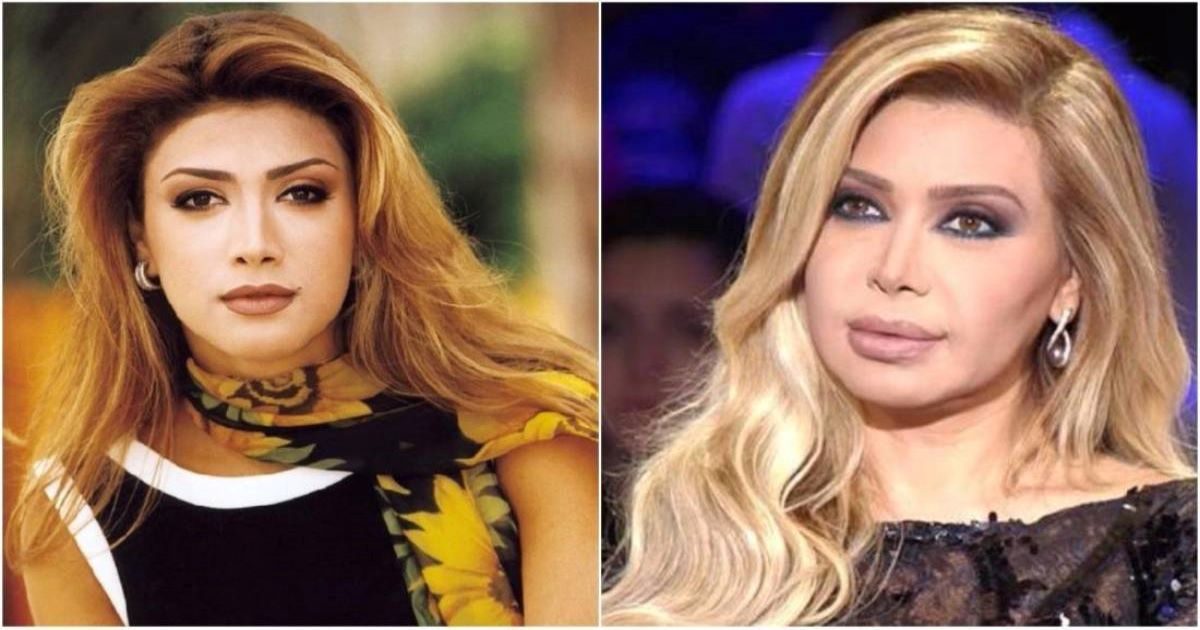 التبدلات قبل وبعد فيلر الشفايف